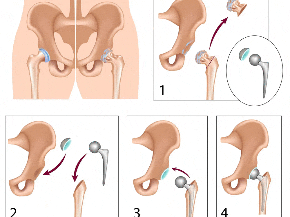 total-hip-replacement-illustration-a7c81c