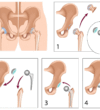 total-hip-replacement-illustration-a7c81c