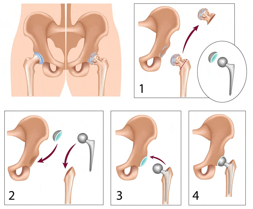 total-hip-replacement-illustration-a7c81c